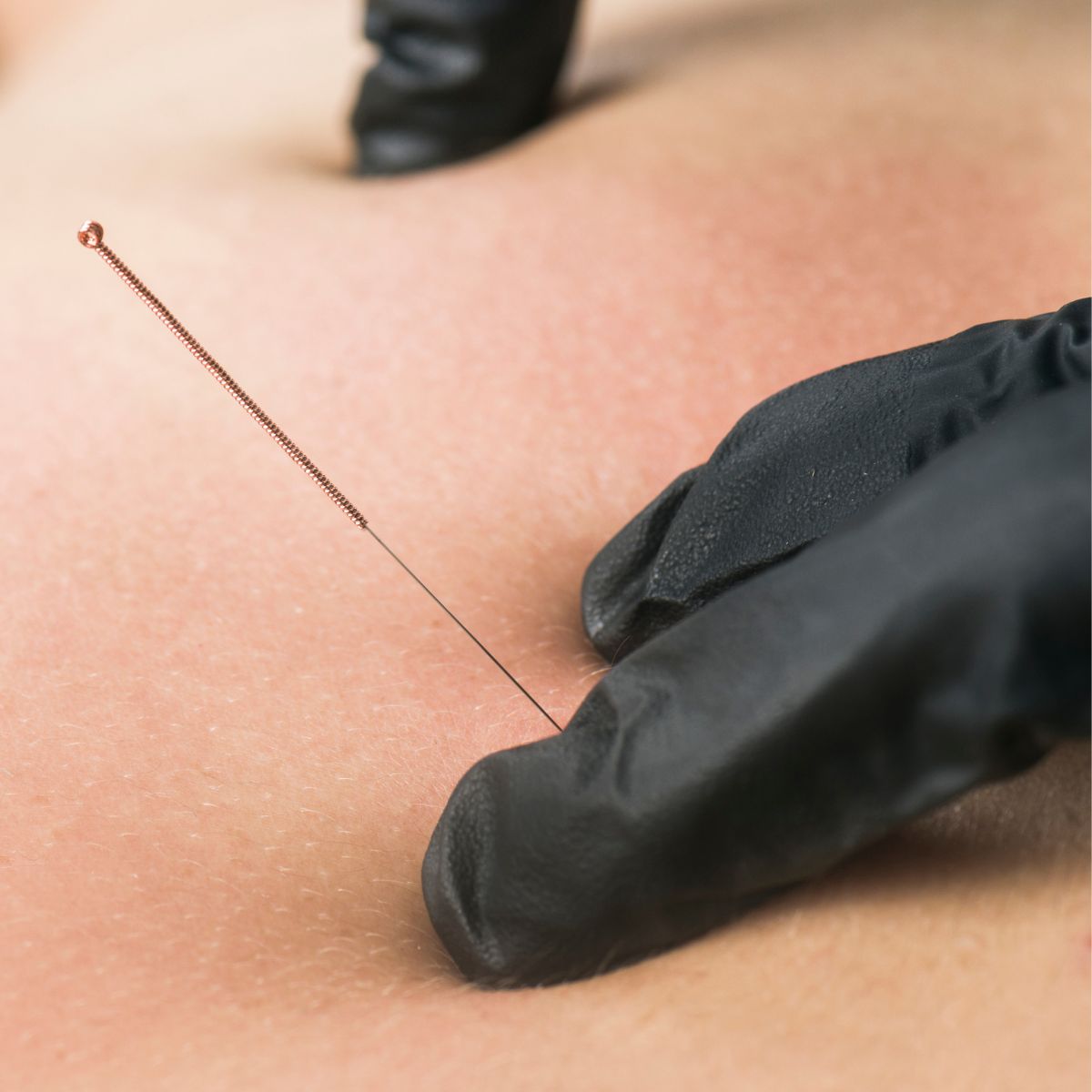 Does Dry Needling Hurt?