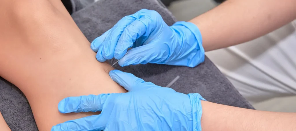 Dry Needling